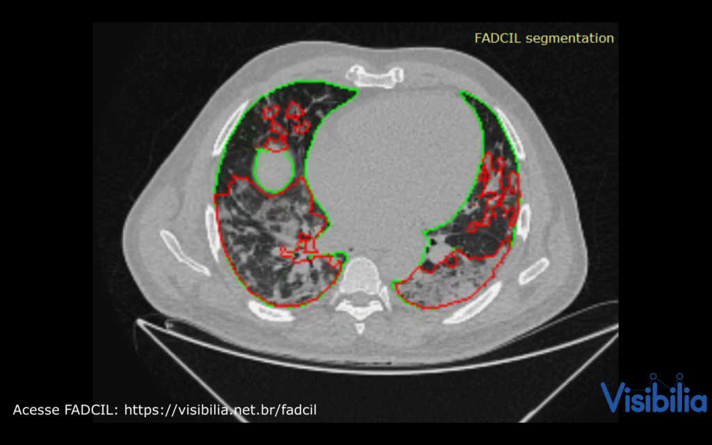 FADCIL - IA para diagnóstico de COVID-19 usando imagens medicas da Visibilia - lung segmentation for covid-19 detection